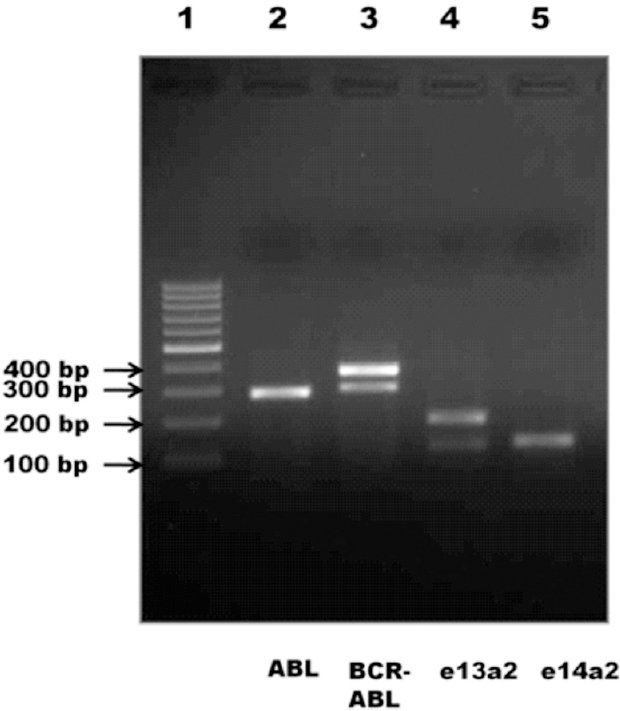 Agarose gel electrophoresis of dual transcript samples. Lane 1- 100 bp ladder, lane 2- ABL control (288 bp), lane 3- breakpoint region (BCR-ABL) (e13a2-308 bp and e14a2-383 bp), lanes 4 and 5- e13a2 (123 bp and 198 bp) and e14a2 (129 bp) transcript specific PCR, respectively.
